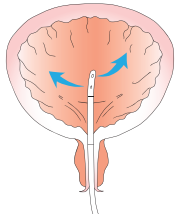 Image of the bladder with catheter inserted