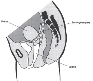 Diagram of Sacrohysteropexy.