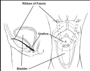 Diagram of an autologous sling