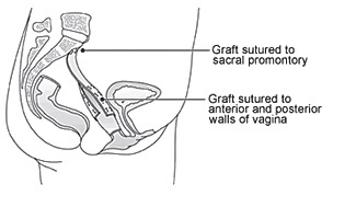 Diagram of Sacrocolpopexy