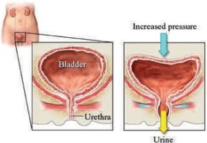 Stress incontinence of urine