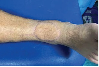 A skin and fat flap 4 months after surgery.