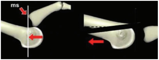 Side view of osteotomy made during surgery