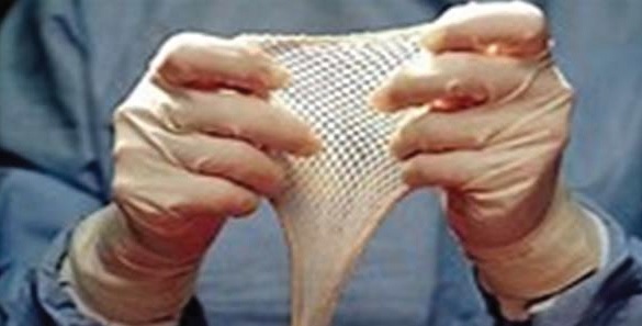 Meshed skin graft