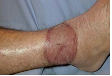 Muscle flap 3 months after the operation.