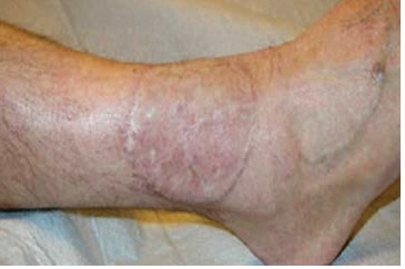 Muscle flap 6 months after the operation.