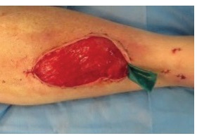Muscle flap day 1 after operation