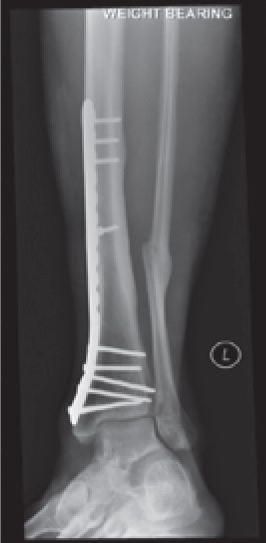 Plate and screws bony fixation
