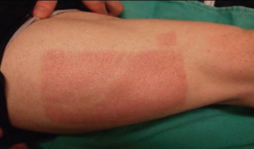 Recently healed skin graft donor site on the thigh