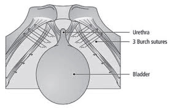 Laparoscopic colposuspension