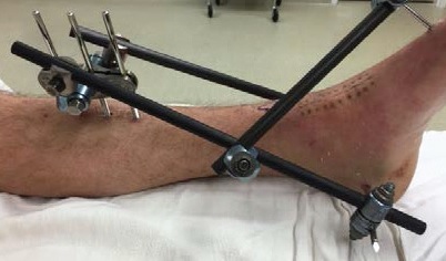 External fixation of the bone