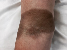 Photo example of stained skin