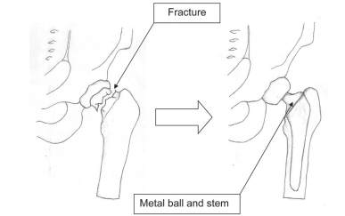 Hip fracture and metal ball and stem