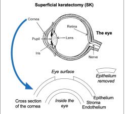 Superficial keratectomy