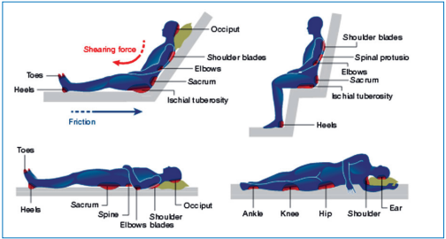 Common body sites for pressure ulcers.