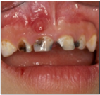 Dental caries image