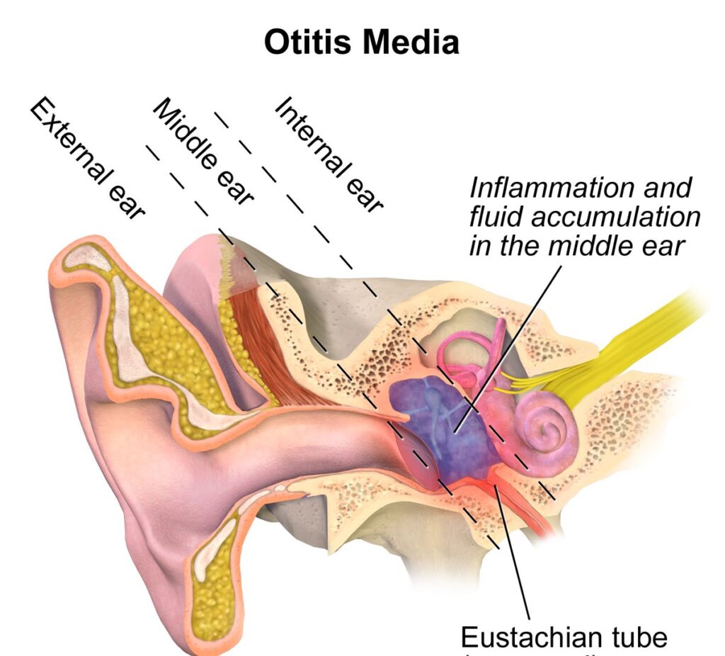 Image of ear showing inflammation and fluid caused by otitis media.