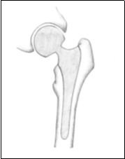 Image of thigh bone