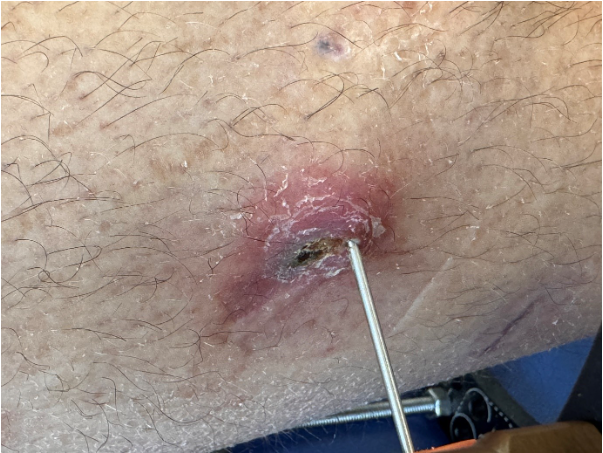 Picture of an irritated pin site