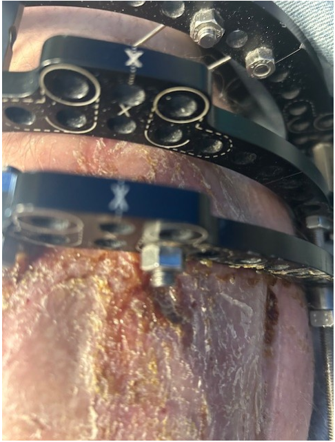 Picture of an infected pin site