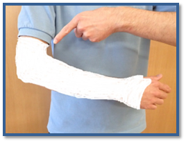 Image showing location of elbow dislocation