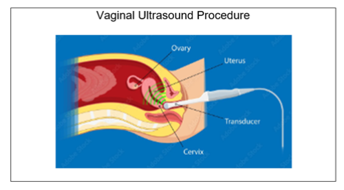 Illustration showing a transvaginal ultrasound scan procedure