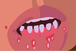 Viral infection (Herpes simplex)