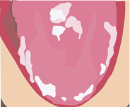 Fungal infection (oral candidiasis)