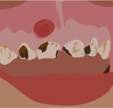 Bacterial infection (untreated tooth decay)