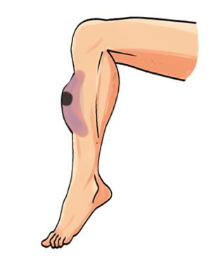A picture of a leg haematoma.