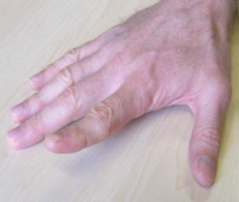 Finger walking, Lift up the index finger and move it towards the thumb.