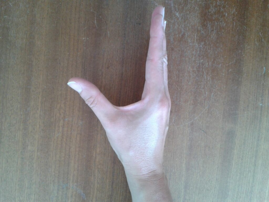 Thumb abduction