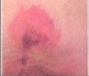 Stage 1 pressure ulcer pale skiin