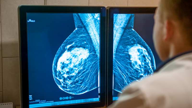 Doctor looking at mammogram